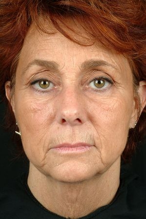 Facelift Before and After Photo by Dr. Hugo in Virginia Beach