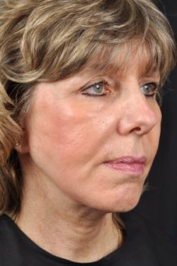 Facelift