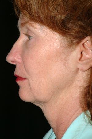 Facelift