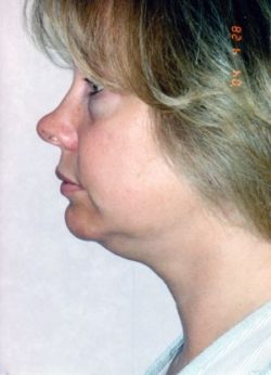 Facial Liposuction