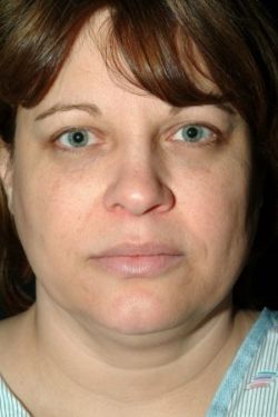 Facial Liposuction