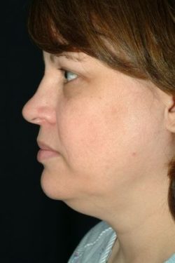 Facial Liposuction