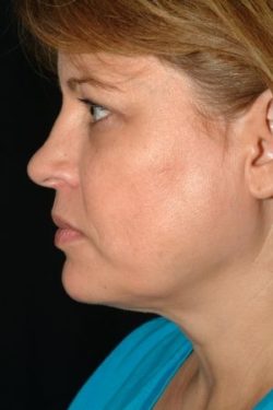 Facial Liposuction