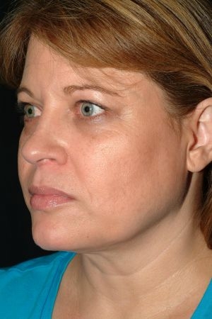 Facial Liposuction