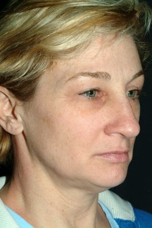 Facial Liposuction