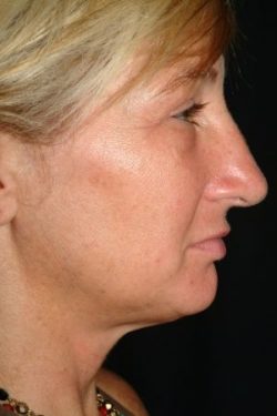 Facial Liposuction