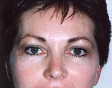 Brow Lift