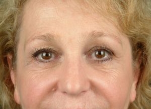 Brow Lift