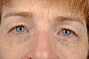 Blepharoplasty (Eyelid Surgery)