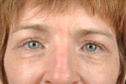 Blepharoplasty (Eyelid Surgery)