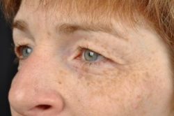 Blepharoplasty (Eyelid Surgery)