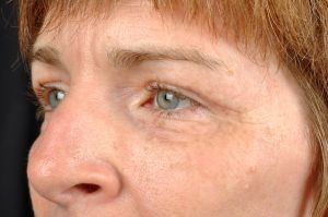 Blepharoplasty (Eyelid Surgery)