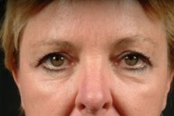 Blepharoplasty (Eyelid Surgery)