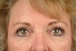 Blepharoplasty (Eyelid Surgery)