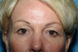 Blepharoplasty (Eyelid Surgery)