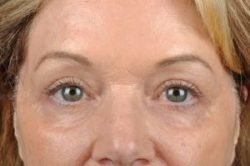 Blepharoplasty (Eyelid Surgery)