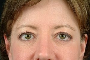 Blepharoplasty (Eyelid Surgery)