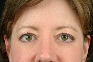 Blepharoplasty (Eyelid Surgery) Case 10 Before Photo Blepharoplasty (Eyelid Surgery)