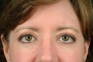 Blepharoplasty (Eyelid Surgery) Case 10 After Photo Blepharoplasty (Eyelid Surgery)