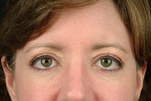 Blepharoplasty (Eyelid Surgery)