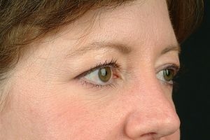 Blepharoplasty (Eyelid Surgery) Case 10 Before Photo Blepharoplasty (Eyelid Surgery)