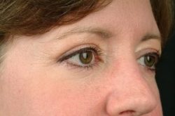 Blepharoplasty (Eyelid Surgery)