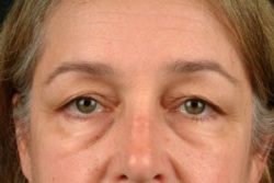 Blepharoplasty (Eyelid Surgery)