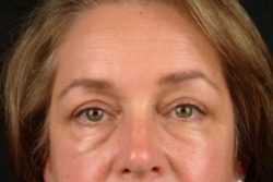 Blepharoplasty (Eyelid Surgery)