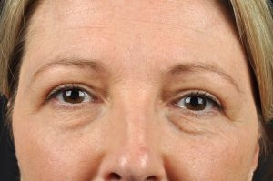 Blepharoplasty (Eyelid Surgery)