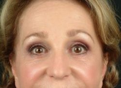 Blepharoplasty (Eyelid Surgery)