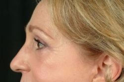 Blepharoplasty (Eyelid Surgery)