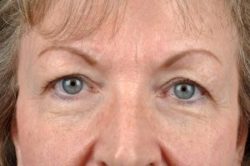 Blepharoplasty (Eyelid Surgery)