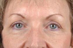 Blepharoplasty (Eyelid Surgery)