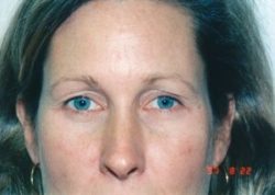 Blepharoplasty (Eyelid Surgery)