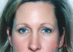 Blepharoplasty (Eyelid Surgery)