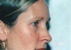 Blepharoplasty (Eyelid Surgery)