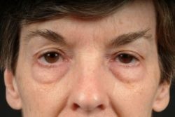 Blepharoplasty (Eyelid Surgery)