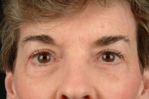 Blepharoplasty (Eyelid Surgery)