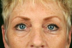 Blepharoplasty (Eyelid Surgery)