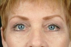 Blepharoplasty (Eyelid Surgery)