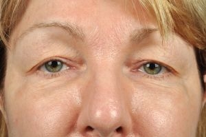 Blepharoplasty (Eyelid Surgery)