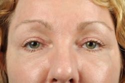 Blepharoplasty (Eyelid Surgery)