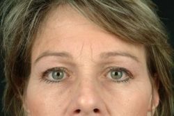 Blepharoplasty (Eyelid Surgery)