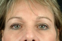 Blepharoplasty (Eyelid Surgery)