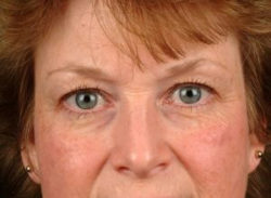 Blepharoplasty (Eyelid Surgery)