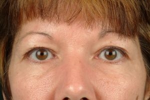 Blepharoplasty (Eyelid Surgery)