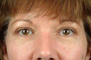 Blepharoplasty (Eyelid Surgery)