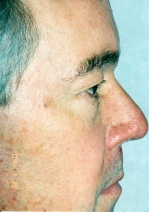 Blepharoplasty (Eyelid Surgery)