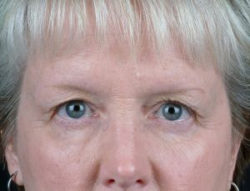 Blepharoplasty (Eyelid Surgery)