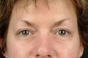 Blepharoplasty (Eyelid Surgery)